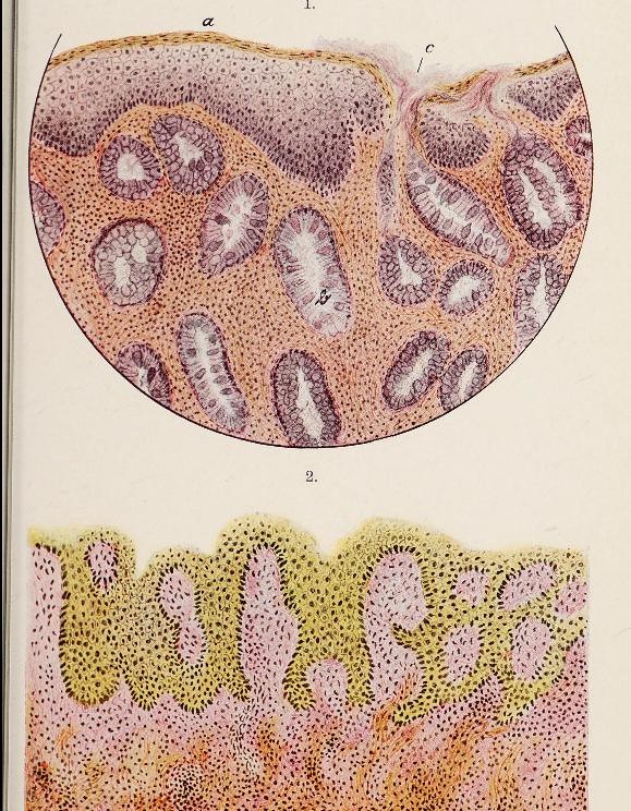 Neoplasms