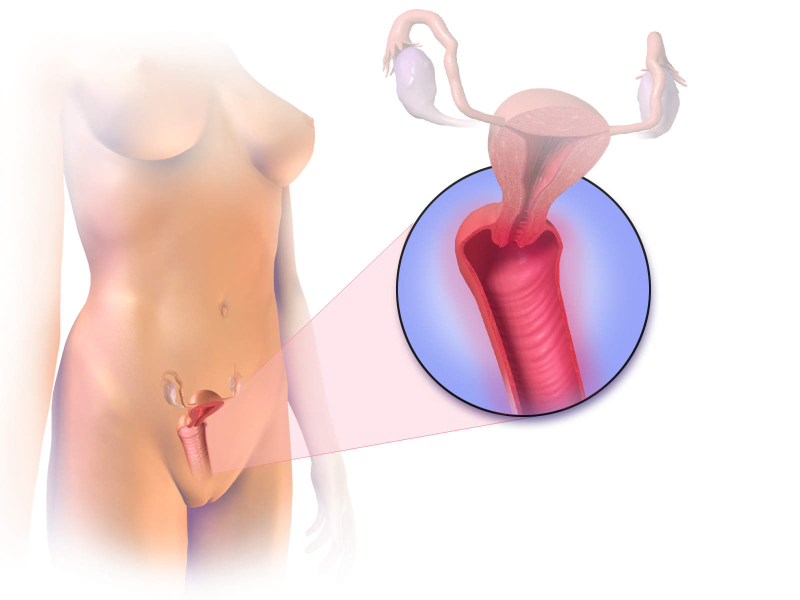 Atrophic Vaginitis