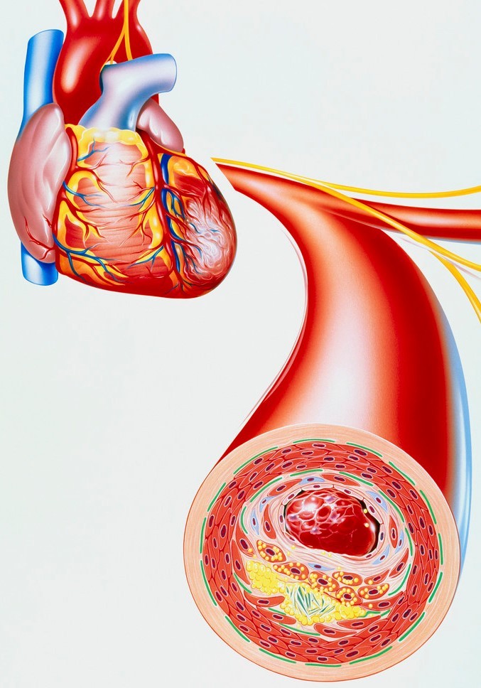 Ischemic Heart Disease