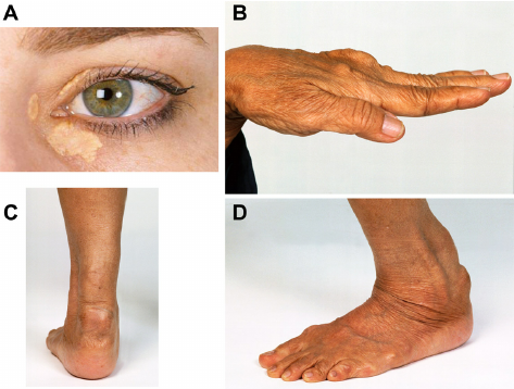 Hypercholesterolemia